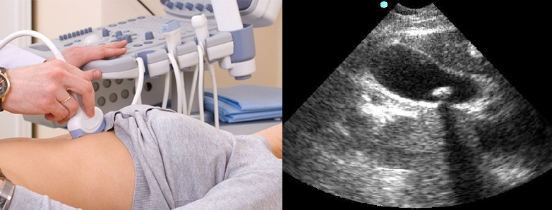 УЗИ желчного пузыря